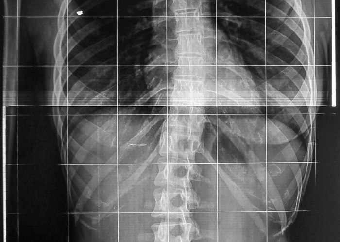 Radiografia tronco